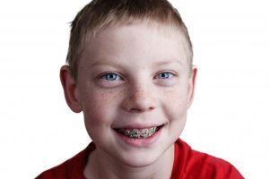 child with braces