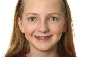 young girl with braces 