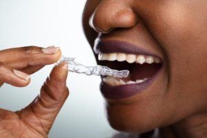 woman putting in a clear aligner 