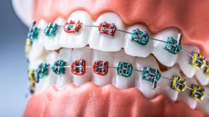 picture of model teeth with braces