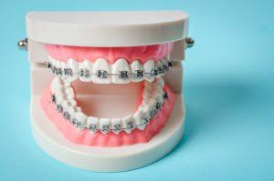 model teeth with metal braces 