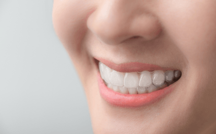 Comfortable, custom-made aligners